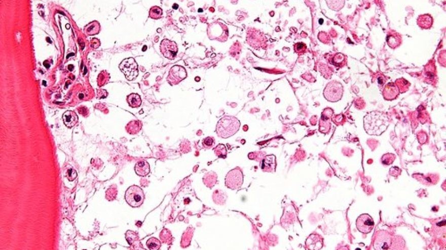 A micrograph showing crinkled paper macrophages in the marrow space in a case of Gaucher disease. Credit: Nephron via Wikimedia Commons.
