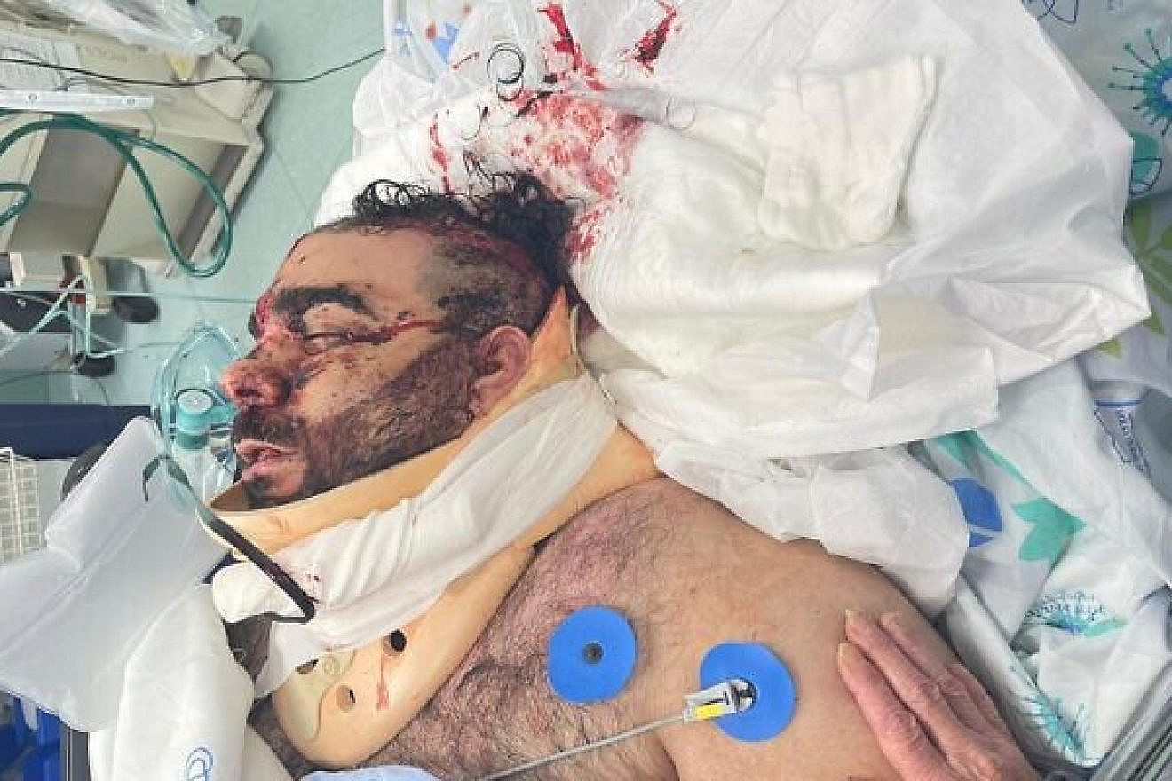 Mor Ganashvili in the hospital, soon after he was attacked, May 2021. Courtesy photo.