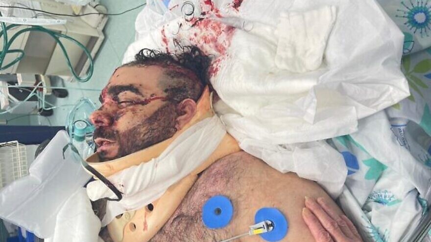 Mor Ganashvili in the hospital, soon after he was attacked, May 2021. Courtesy photo.
