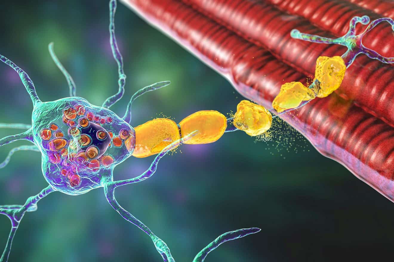 Brain neurons associated with Tay-Sachs disease: A 3D-illustration shows swollen neurons with membraneous lamellar inclusions due to accumulation of gangliosides in lysosomes and demyelination. Credit: Kateryna Kon/Shutterstock.